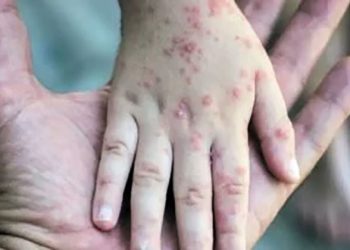 الصحة العالمية: يجب توفير 87.4 مليون دولار لمواجهة تفشى جدرى القرود