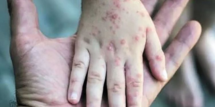 الصحة العالمية: يجب توفير 87.4 مليون دولار لمواجهة تفشى جدرى القرود