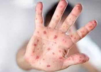 الفلبين تعلن إصابة حالتين جديدتين بفيروس جدرى القرود