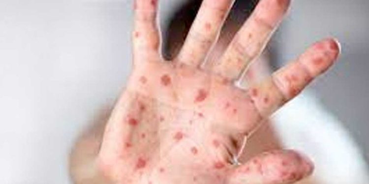 الفلبين تعلن إصابة حالتين جديدتين بفيروس جدرى القرود