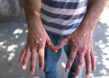 الكونغو تعلن اكتشاف أكثر من 1000 إصابة جديدة بجدرى القردة فى أسبوع