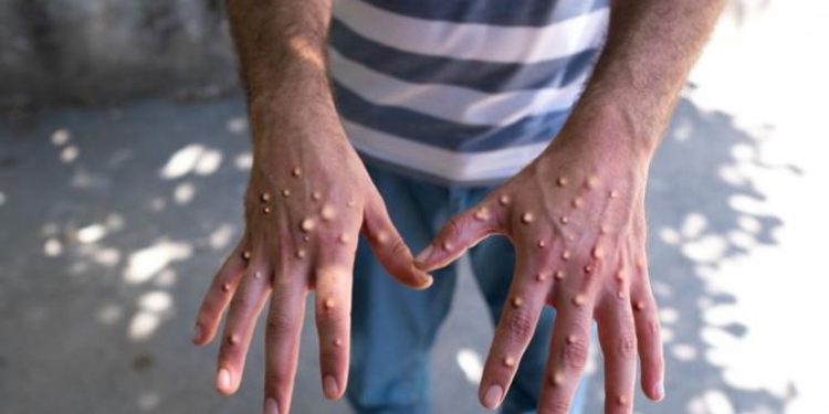 الكونغو تعلن اكتشاف أكثر من 1000 إصابة جديدة بجدرى القردة فى أسبوع