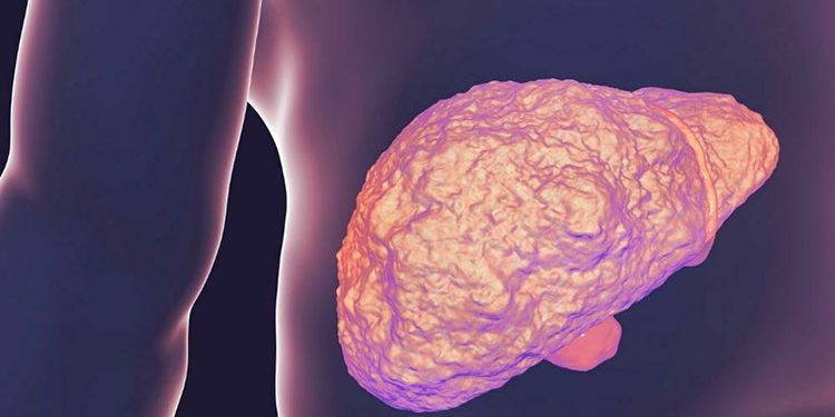 أعراض تقدم تليف الكبد