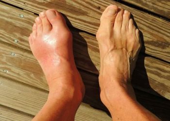 أسباب غير متوقعة تصيبك بمرض النقرس