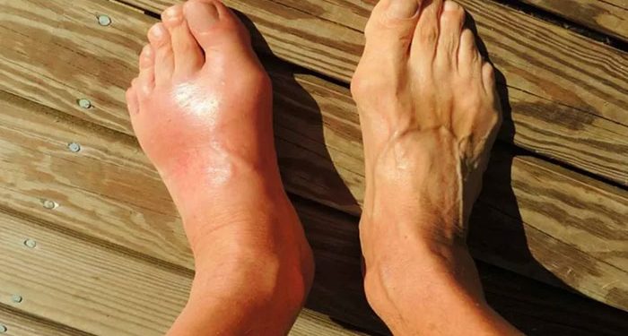 أسباب غير متوقعة تصيبك بمرض النقرس