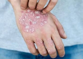 هؤلاء الأشخاص أكثر عرضة للإصابة بالصدفية