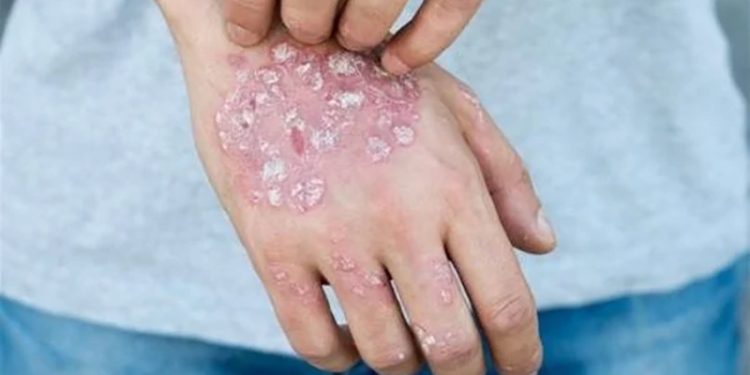 هؤلاء الأشخاص أكثر عرضة للإصابة بالصدفية