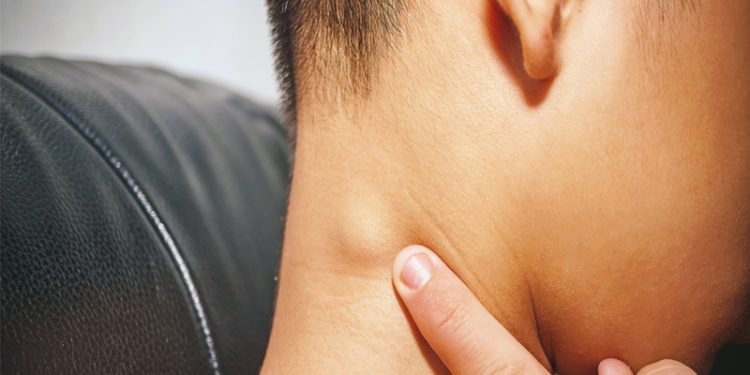 أسباب التهاب الغدد الليمفاوية وأعراضها