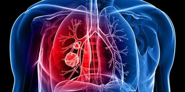 تعرف على أنواع سرطان الرئة