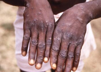 مدير الصحة العالمية: لا يزال جدرى القرود يشكل حالة طوارئ عامة تثير قلقا دوليا