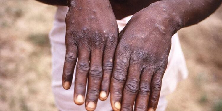 مدير الصحة العالمية: لا يزال جدرى القرود يشكل حالة طوارئ عامة تثير قلقا دوليا