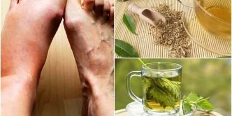 مشروبات طبيعية تخفض مستوى حمض اليوريك