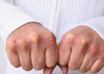 أسباب جفاف وتشقق اليدين في الشتاء