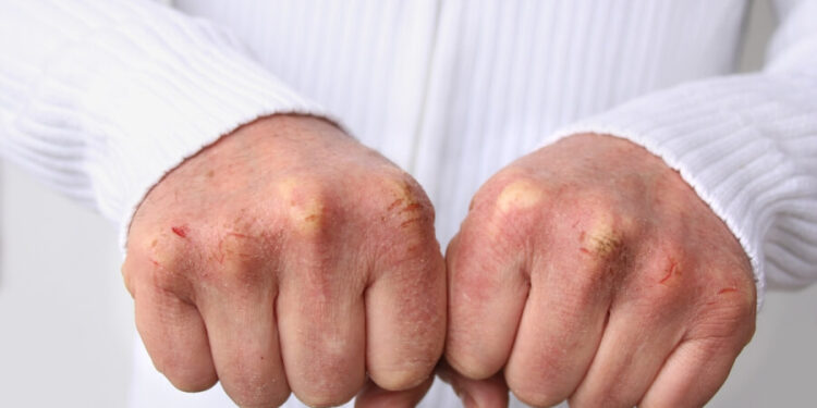 أسباب جفاف وتشقق اليدين في الشتاء