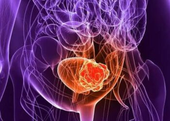 هؤلاء الأكثر عرضة للإصابة بمرض سرطان المثانة