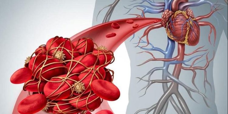 4 مشروبات طبيعية تحميك من خطر الجلطات المفاجئة وتحسن صحة قلبك