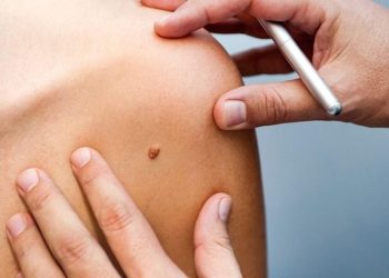 علامة صغيرة قد تكون إنذارا مبكرا لسرطان الجلد