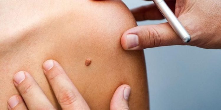 علامة صغيرة قد تكون إنذارا مبكرا لسرطان الجلد
