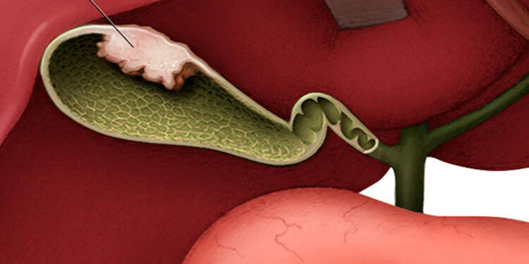 الأشخاص الأكثر عرضة للإصابة بسرطان المرارة