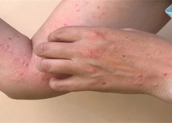 الصحة العالمية: جدرى القرود لا يزال يشكل حالة طوارئ صحية عامة تثير قلقا دوليا