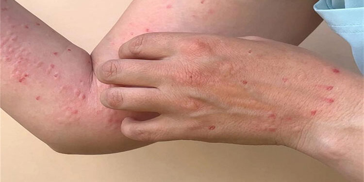 الصحة العالمية: جدرى القرود لا يزال يشكل حالة طوارئ صحية عامة تثير قلقا دوليا