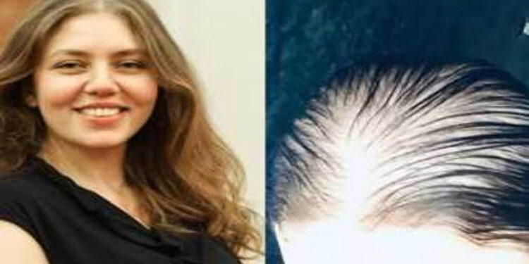 رحمة حسن ترفض اعتذار العياده المتسببة في سقوط شعرها