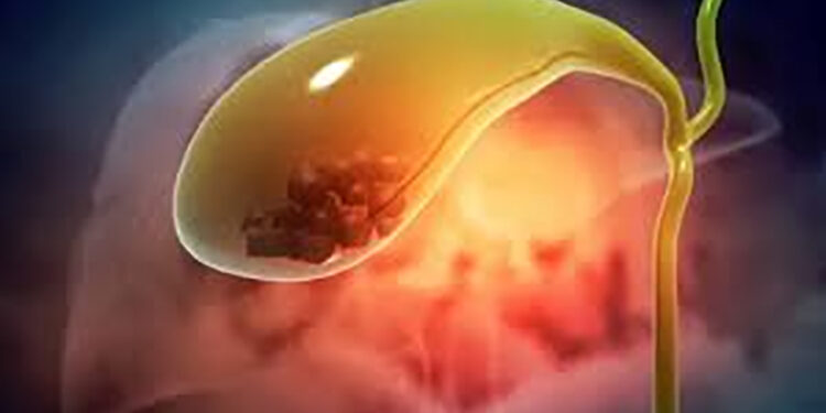 5 أعراض مبكرة قد تشير إلى مشاكل في المرارة