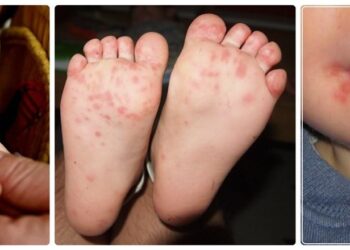 الصحة تكشف حقيقة إغلاق المدارس بسبب مرض اليد والقدم والفم