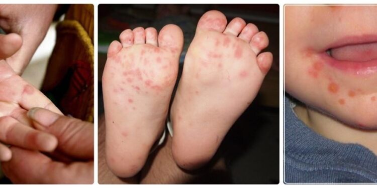 بيان من الصحة والتعليم بشأن مرض اليد والقدم والفم وحقيقة إغلاق المدارس