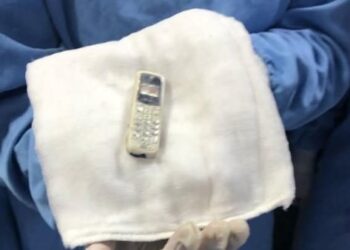 استخراج هاتف محمول من بطن مريض بعد 11 شهرا بمركز الجهاز الهضمي بالمنصورة