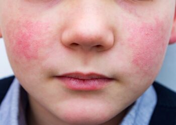 عدوى فيروسية غير معروفة بالمدارس تثير ذعر الأمهات.. والصحة ترد