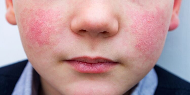 عدوى فيروسية غير معروفة بالمدارس تثير ذعر الأمهات.. والصحة ترد