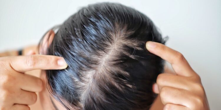 خبير أمراض جلدية: الإفراط في غسل الشعر يسبب جفاف فروة الرأس وتقصفه