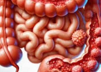 مضاعفات التهاب القولون التقرّحي.. مخاطر يجب الانتباه لها