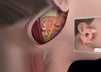 تشبه الانفلونزا .. اكتشف أعراض غدة النكاف