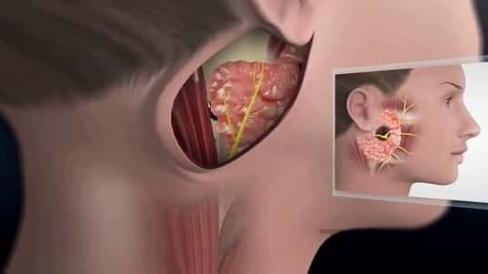 تشبه الانفلونزا .. اكتشف أعراض غدة النكاف