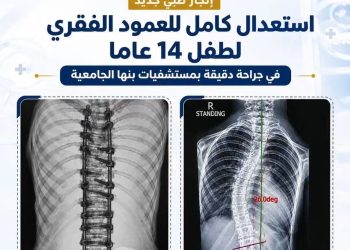 التعليم العالي: استعدال كامل للعمود الفقري لطفل 14 عامًا بمستشفيات جامعة بنها