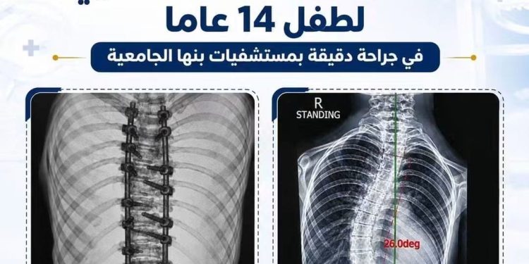 التعليم العالي: استعدال كامل للعمود الفقري لطفل 14 عامًا بمستشفيات جامعة بنها